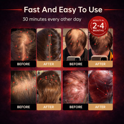 🔥 Last Chance! Mresio® Red Light Cap — Regrow Hair, Reduce Shedding & Bring Back What You Thought Was Gone